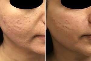 Fractional Laser Scar Session