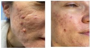 Fractional Laser Scar Session