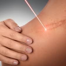 Laser Scar Removal