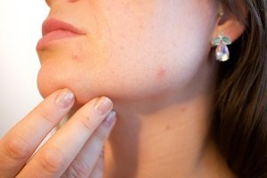 Laser Scar Removal