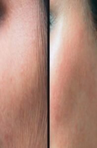 American Candela device results