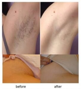Italian Diode Laser
