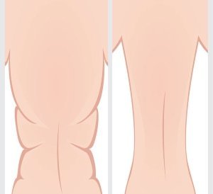 The Difference Between Skin Tightening, Body Contouring, and Fat Dissolution