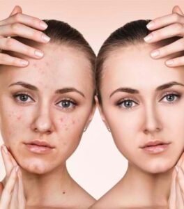 Acne Treatment