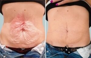 Body Tightening Device