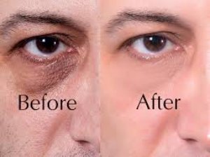 Dark Circles Treatment