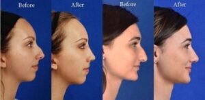 Rhinoplasty in Kuwait