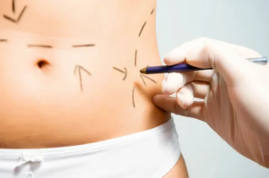 Body Contouring